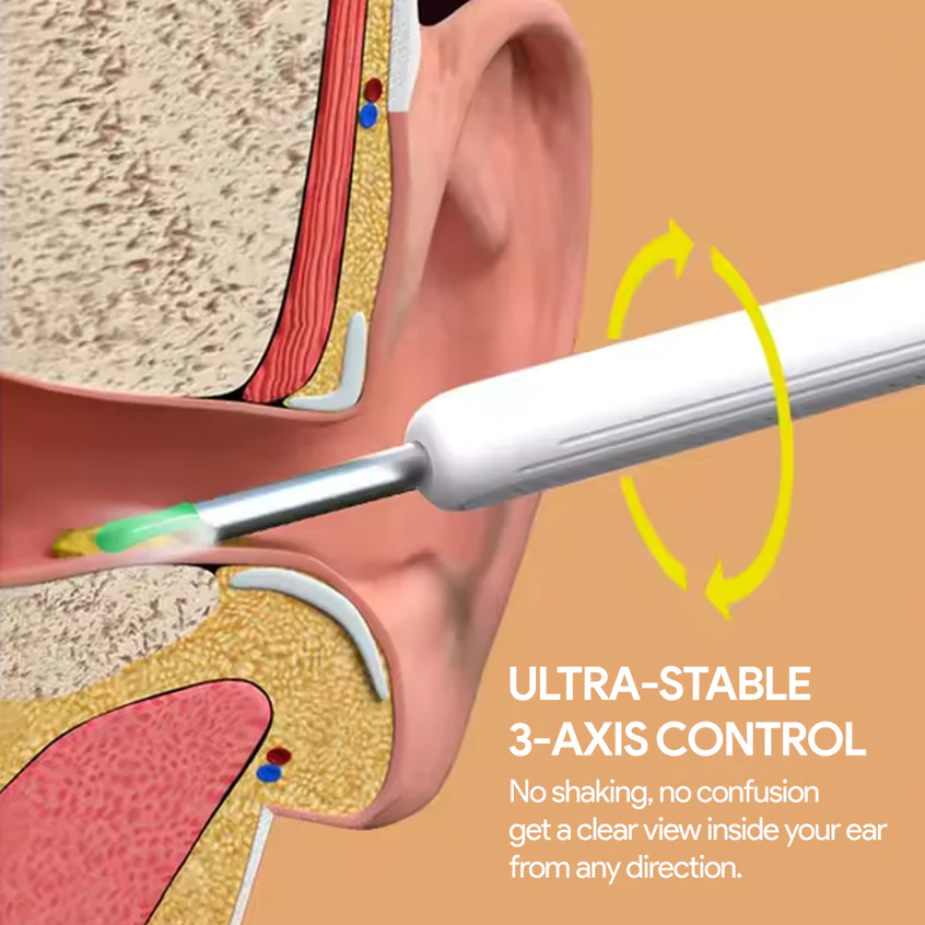 Anatomical illustration showing how a slim camera wand navigates the ear canal to reach impacted wax.